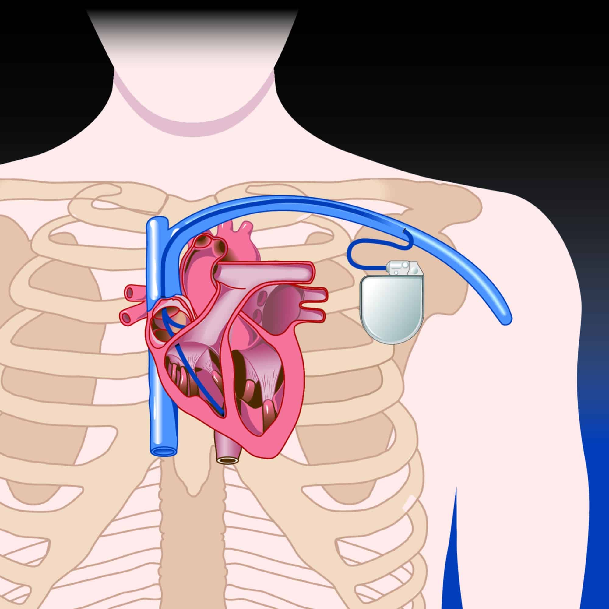 Cardiac Rhythm Device Infections - CT Imaging and Replacement Timing