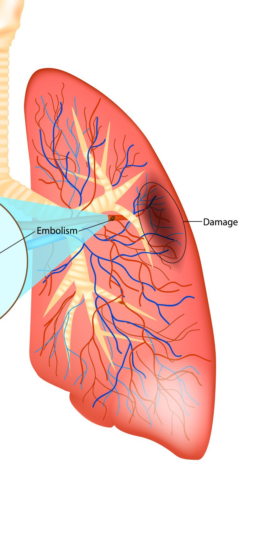 overdiagnosis of pulmonary embolism by pulmonary ct angiography