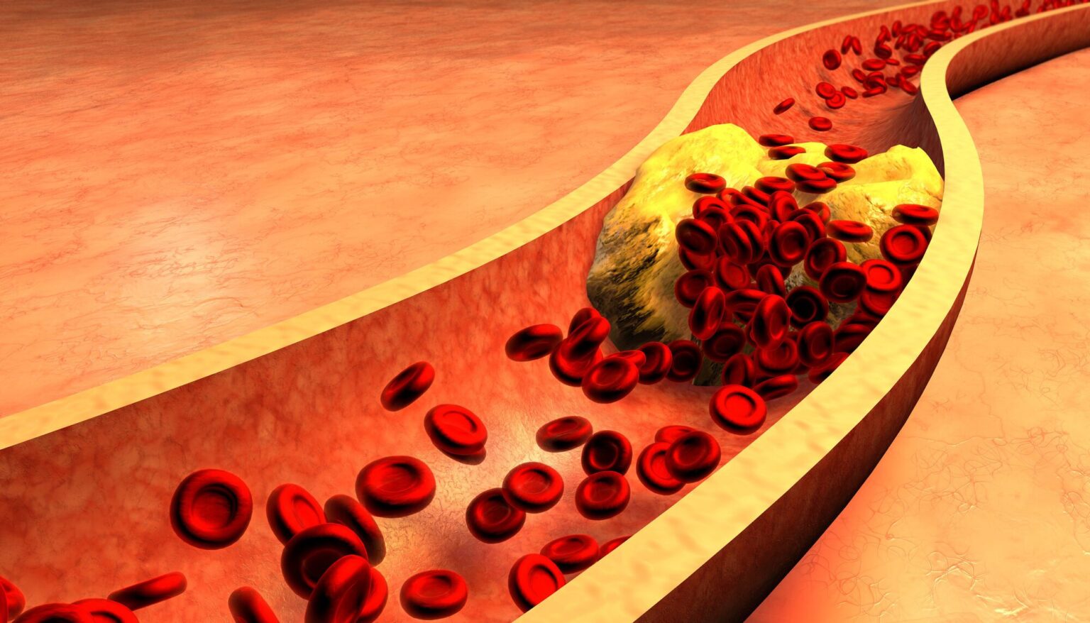 understanding-the-mechanisms-of-coronary-artery-disease