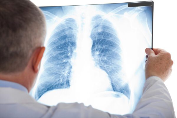 doctor looking at a chest x-ray.